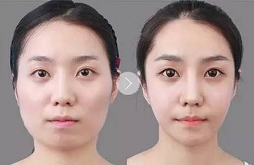 瘦脸前后图