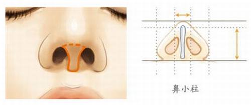 鼻中隔软骨延长鼻小柱