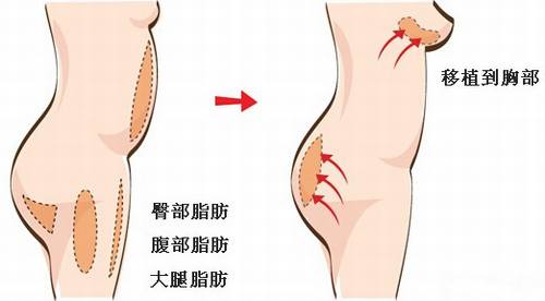 长沙爱思特自体脂肪丰胸费用