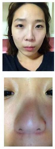 【明美网】整形案例：双眼皮+开眼角+硅胶隆鼻