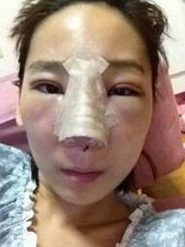 【明美网】整形案例：双眼皮+开眼角+硅胶隆鼻