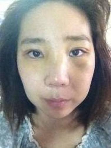 【明美网】整形案例：双眼皮+开眼角+硅胶隆鼻