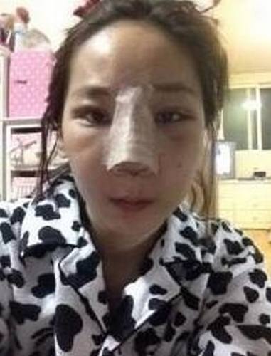 【明美网】整形案例：双眼皮+开眼角+硅胶隆鼻