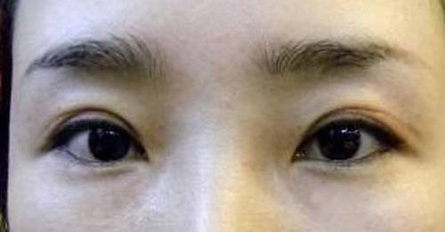 开内眼角+韩式三点双眼皮+鼻尖移植软骨【明美网案例图对比】