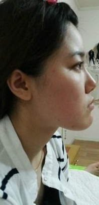 韩式微创双眼皮 硅胶隆鼻 颧骨降低 下颚削骨